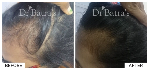 Hair Falling Treatment